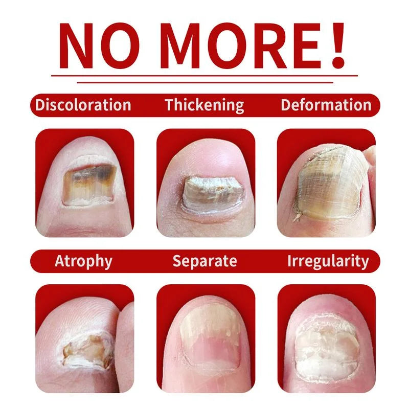 HerbaNail | Kruidenmiddel tegen schimmelnagels voor sterke, heldere nagels