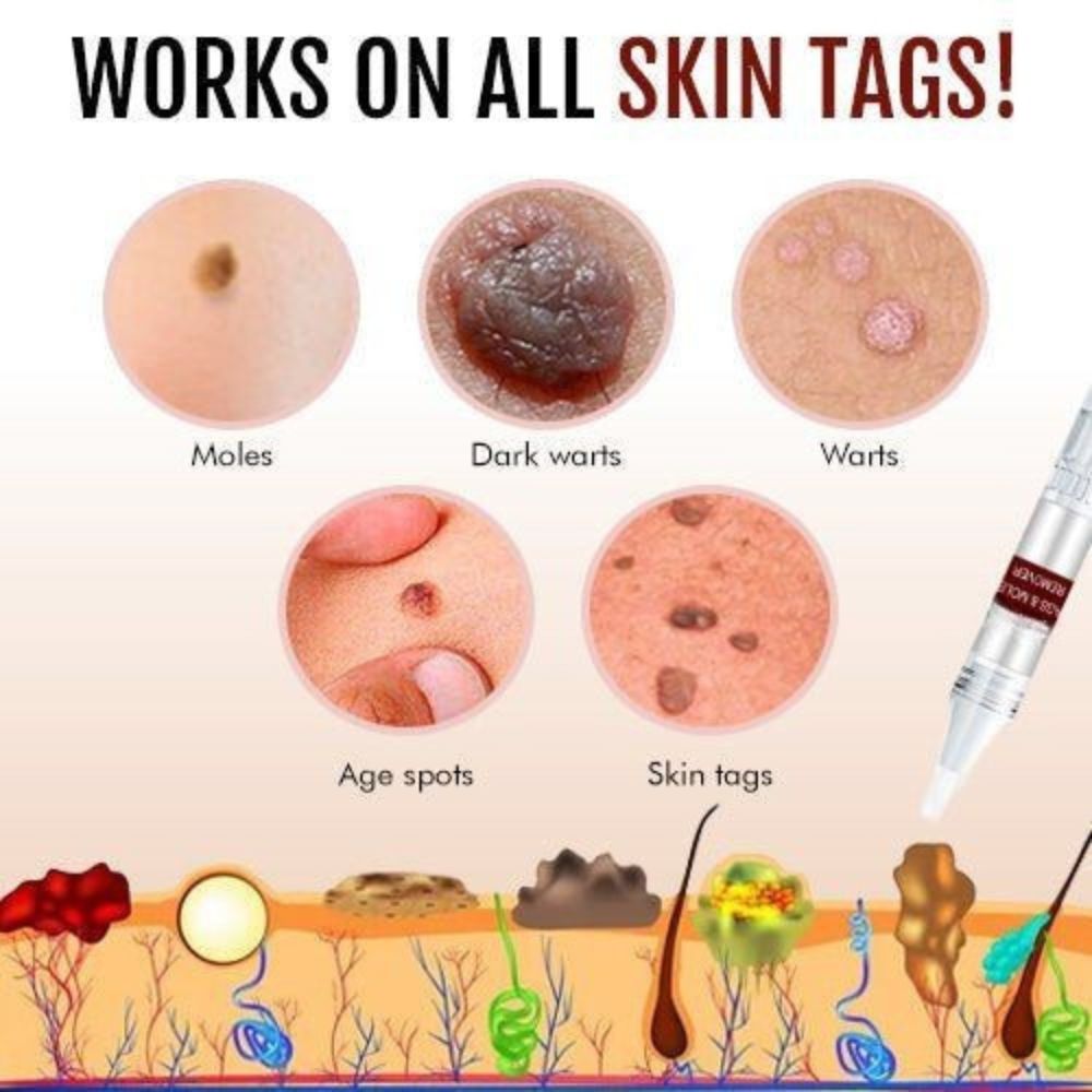 SpotErase | Huidtag- en moedervlekverwijderingspen, veilige en effectieve spotbehandeling, dermatologische verzorging voor thuis