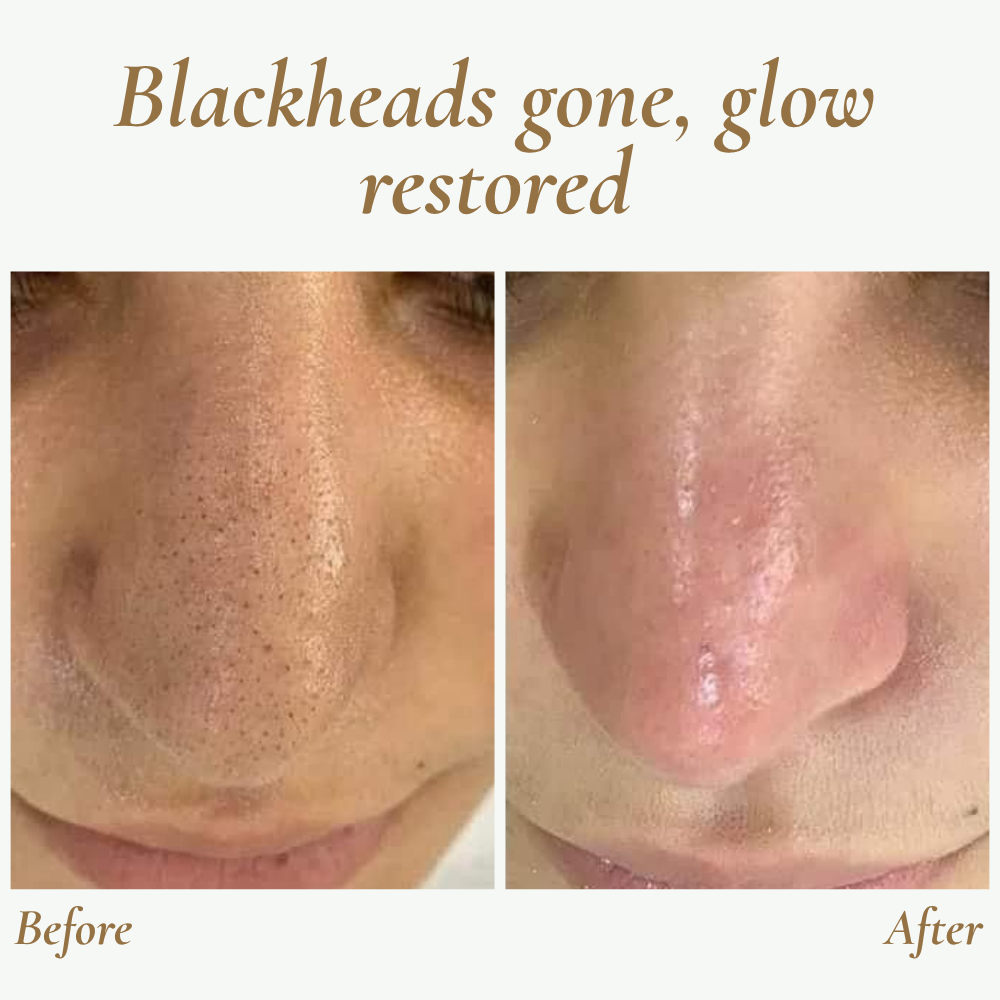 GlowSonic | Professionele draagbare ultrasone gezichtsreinigingsscrubber – Diepe reiniging