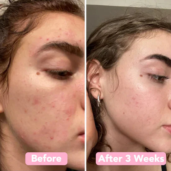 Glowmeric | Kurkuma gezichtsreinigingsspons – Zachte exfoliatie voor de gevoelige, acnegevoelige huid