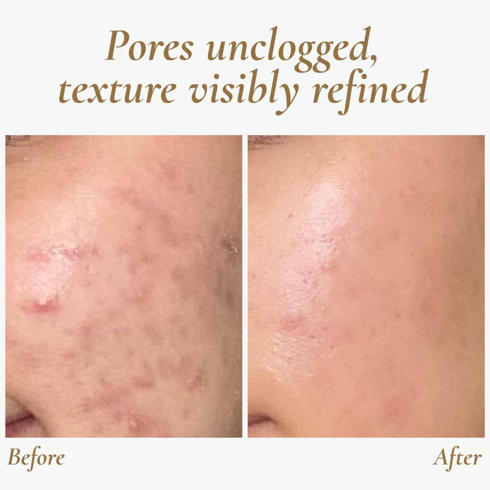 GlowSonic | Professionele draagbare ultrasone gezichtsreinigingsscrubber – Diepe reiniging