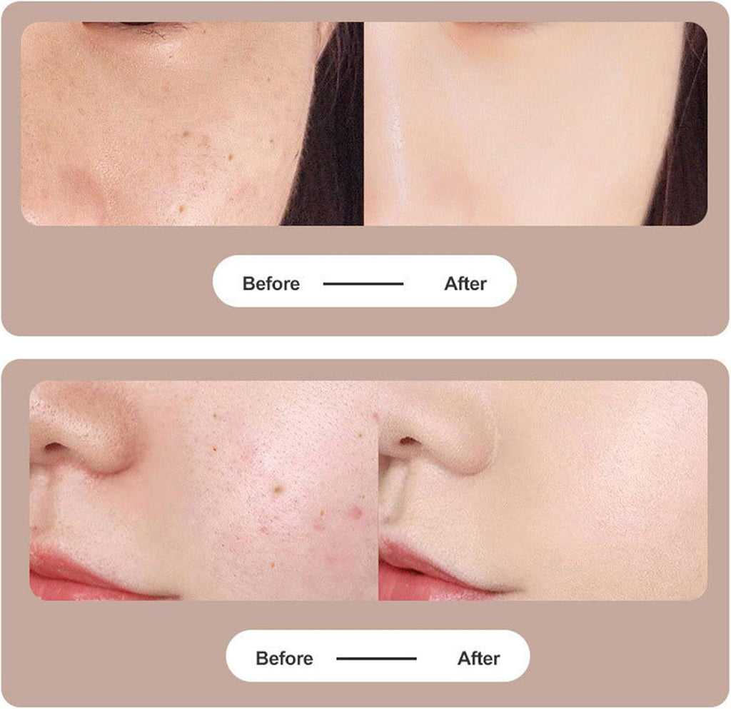 DermaPen | Plasmapen voor het veilig en nauwkeurig verwijderen van huidvlekken, wratten, moedervlekken en huidtags