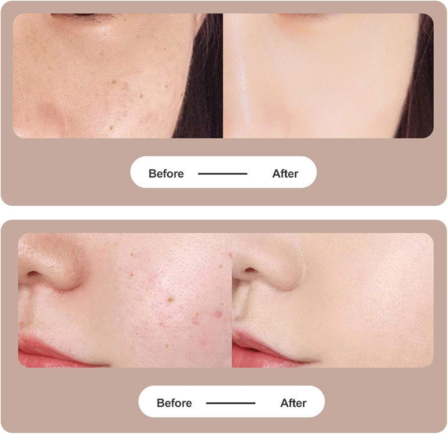 DermaPen | Plasmapen voor het veilig en nauwkeurig verwijderen van huidvlekken, wratten, moedervlekken en huidtags