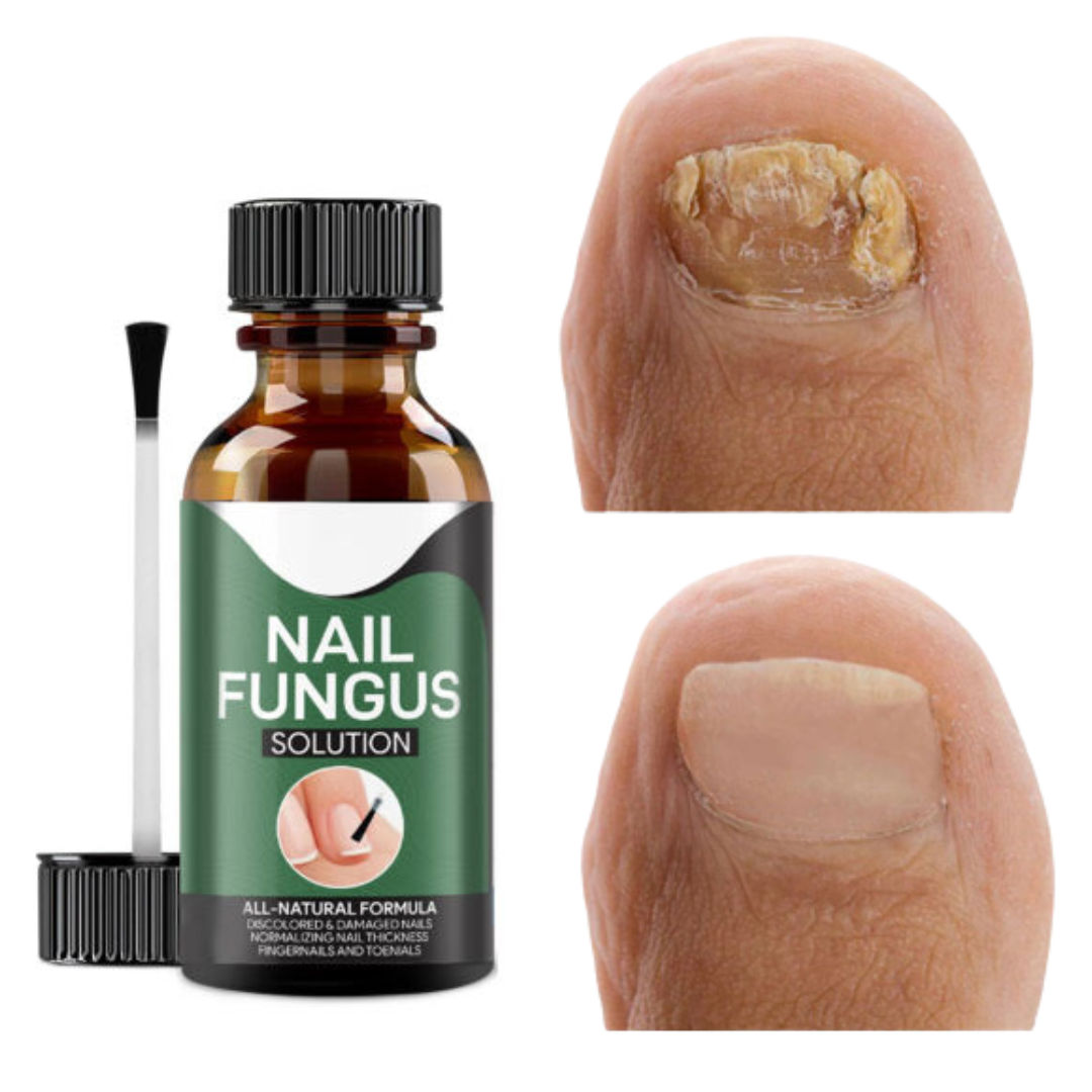 NailCure | Serum voor de behandeling van nagelschimmel, antischimmeldruppels voor teennagels en vingernagels