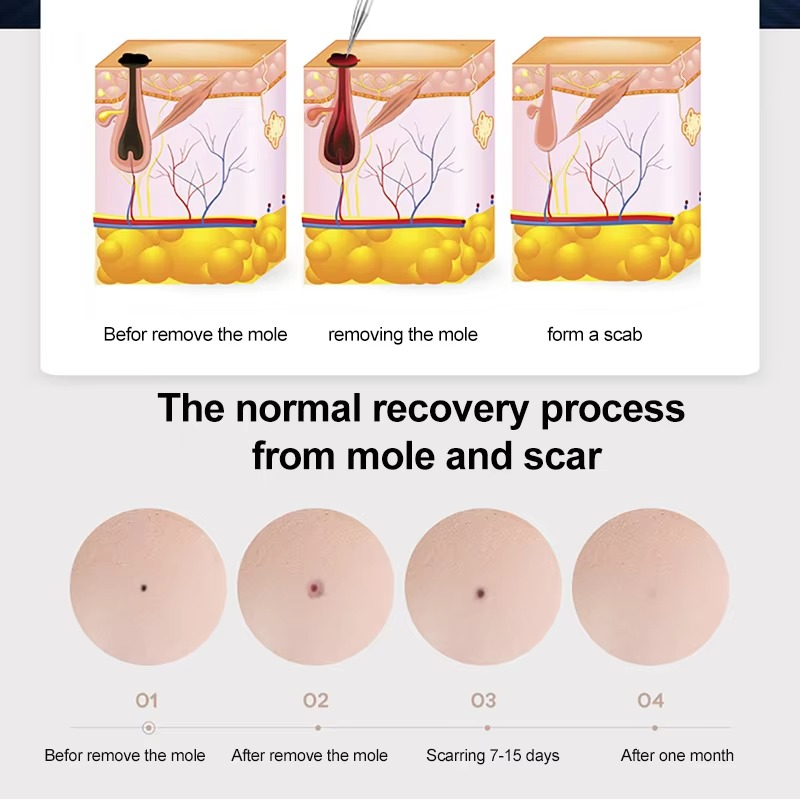 DermaPen | Plasmapen voor het veilig en nauwkeurig verwijderen van huidvlekken, wratten, moedervlekken en huidtags