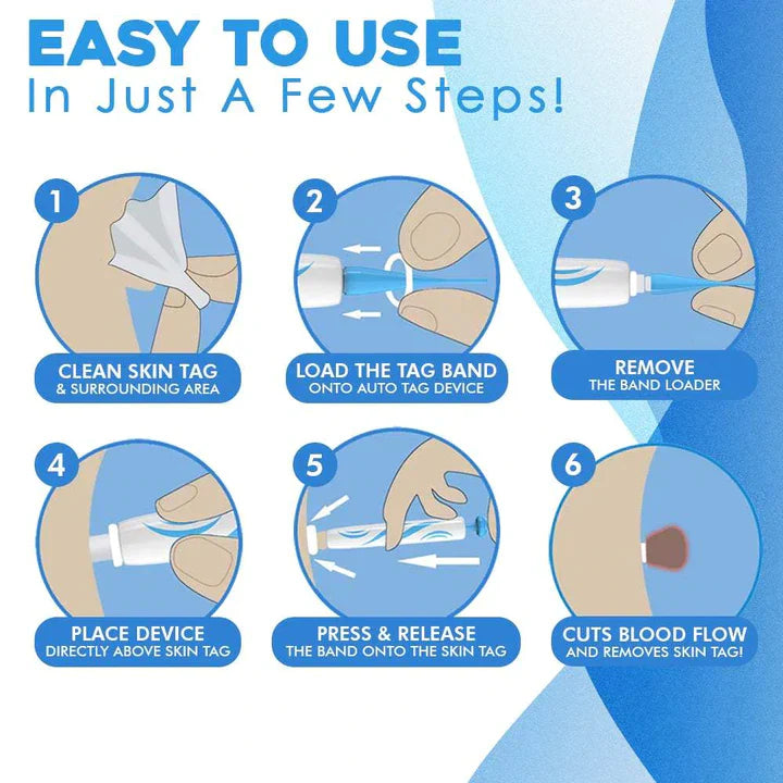 TagZap | Huidtagverwijderingsset - Snel, veilig en effectief wratten en mollen verwijderen