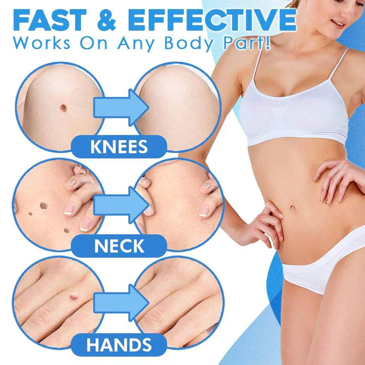 TagZap | Huidtagverwijderingsset - Snel, veilig en effectief wratten en mollen verwijderen