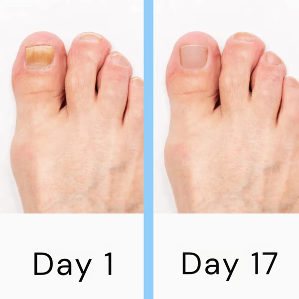 LaserCure | Nagelschimmel laserbehandelingsapparaat – Professionele anti-schimmeltherapie voor teennagels en vingernagels