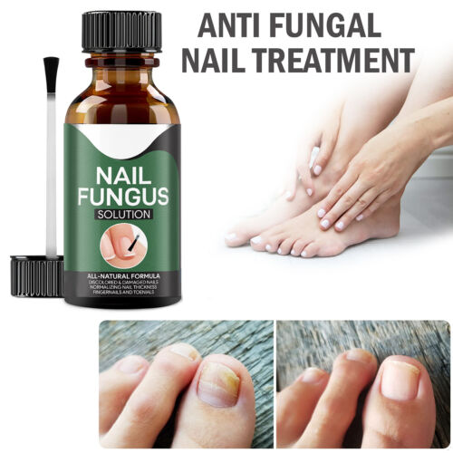 NailCure | Serum voor de behandeling van nagelschimmel, antischimmeldruppels voor teennagels en vingernagels