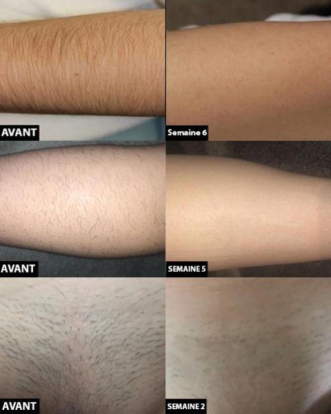 BareRadiance | Permanent laserapparaat voor ontharing – Pijnloos, voor het hele lichaam en gezichtshaarvermindering